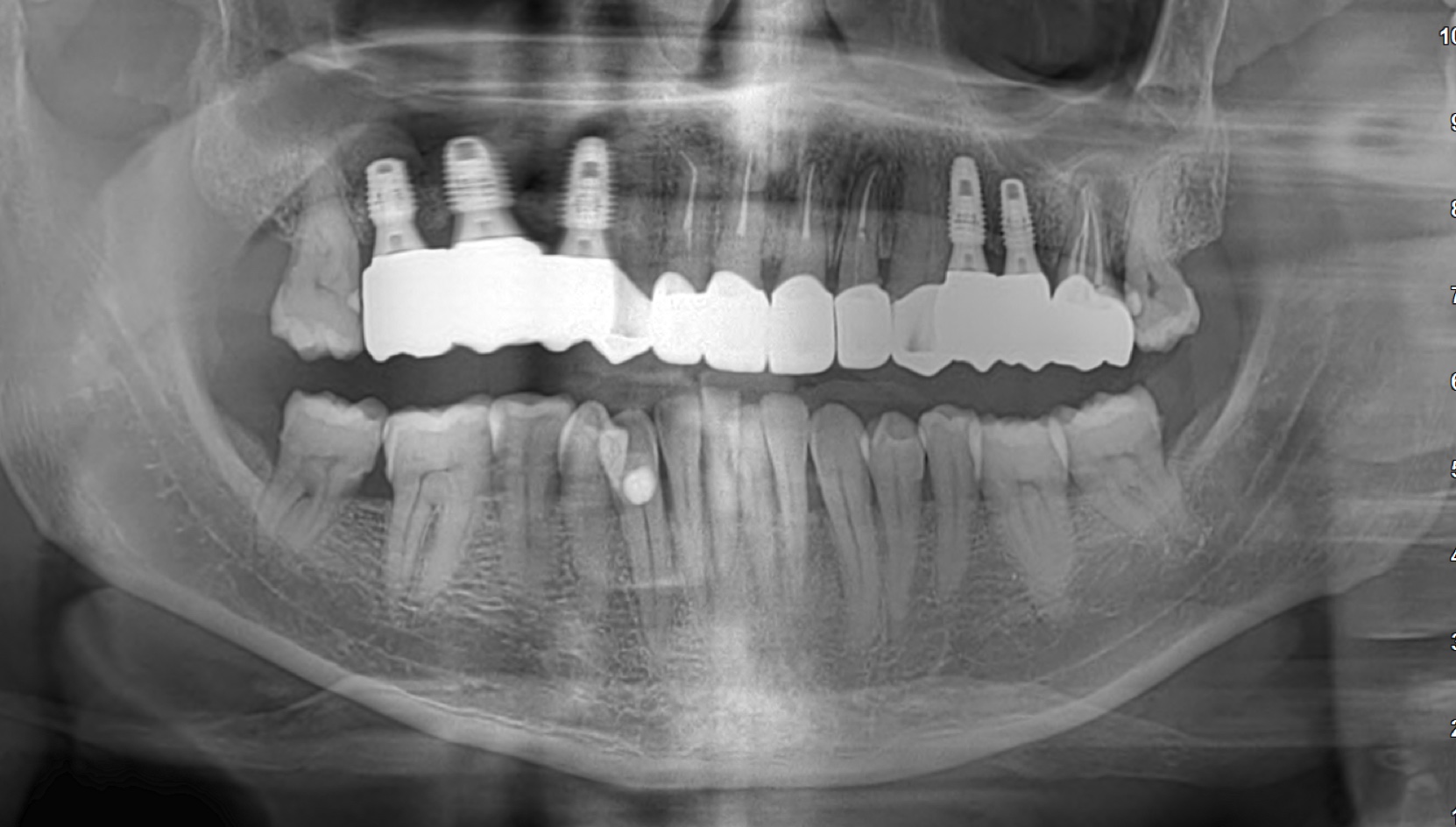 Case 1 Intraoral After