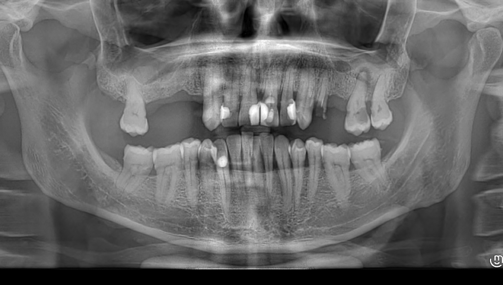 Case 1 Intraoral Before