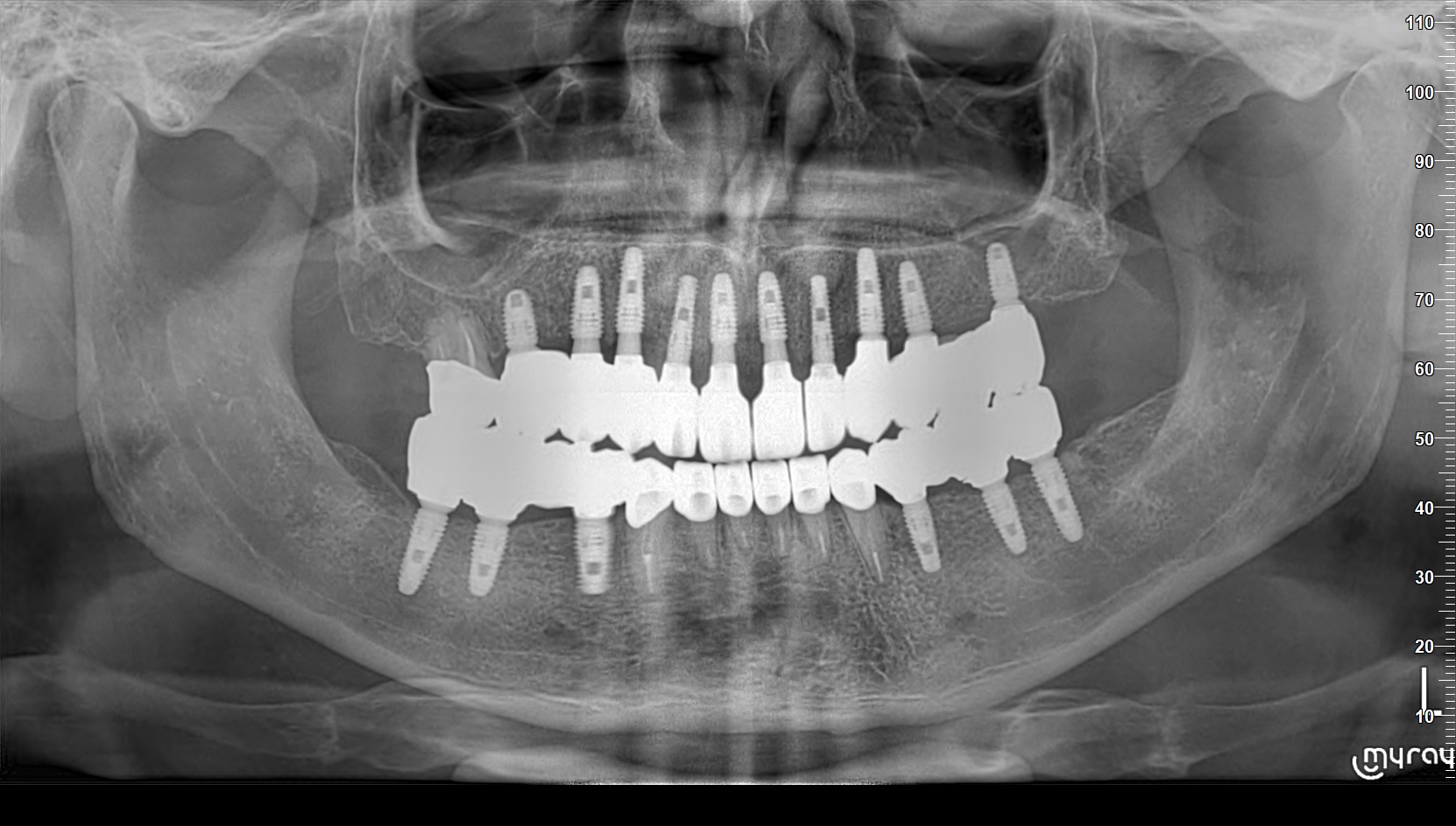 Case 2 Intraoral After