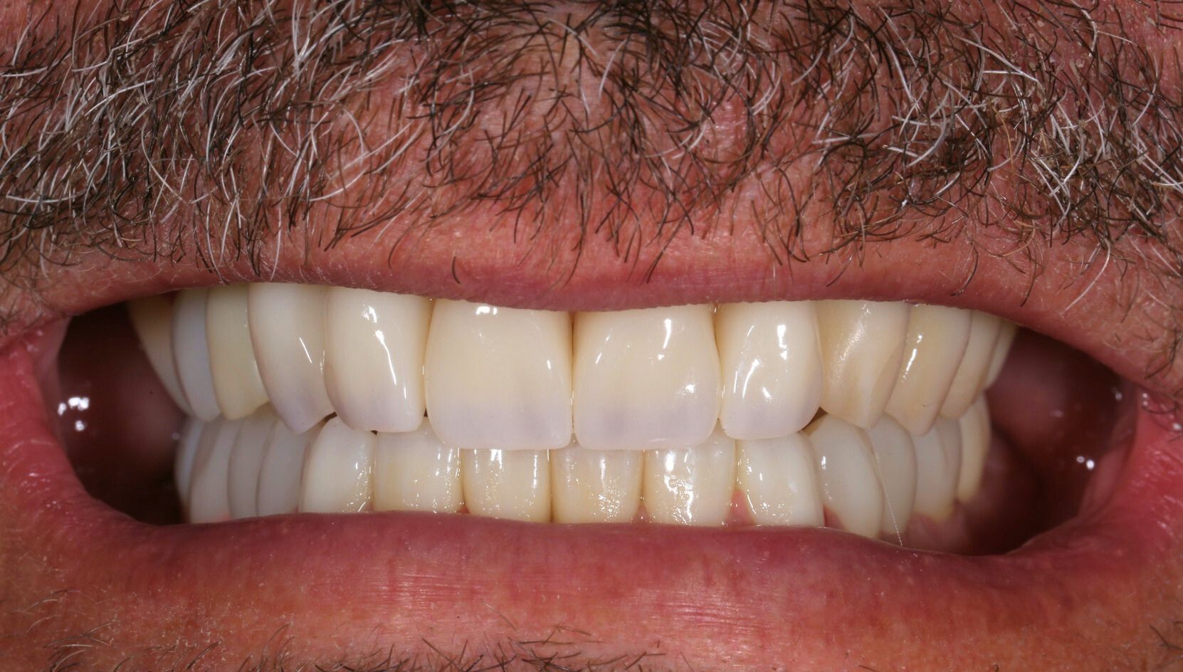 Dental case 2 X-ray after treatment