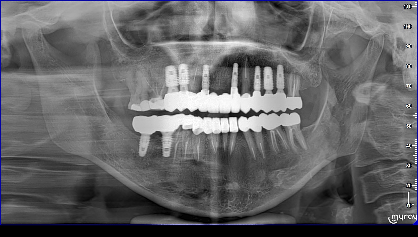 Case 3 Intraoral After