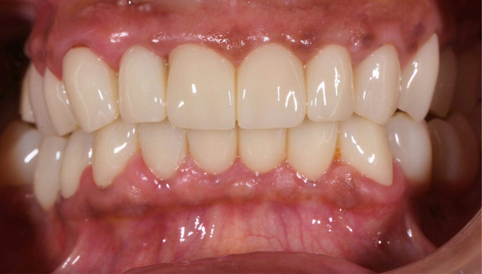 Dental case 4 X-ray after treatment