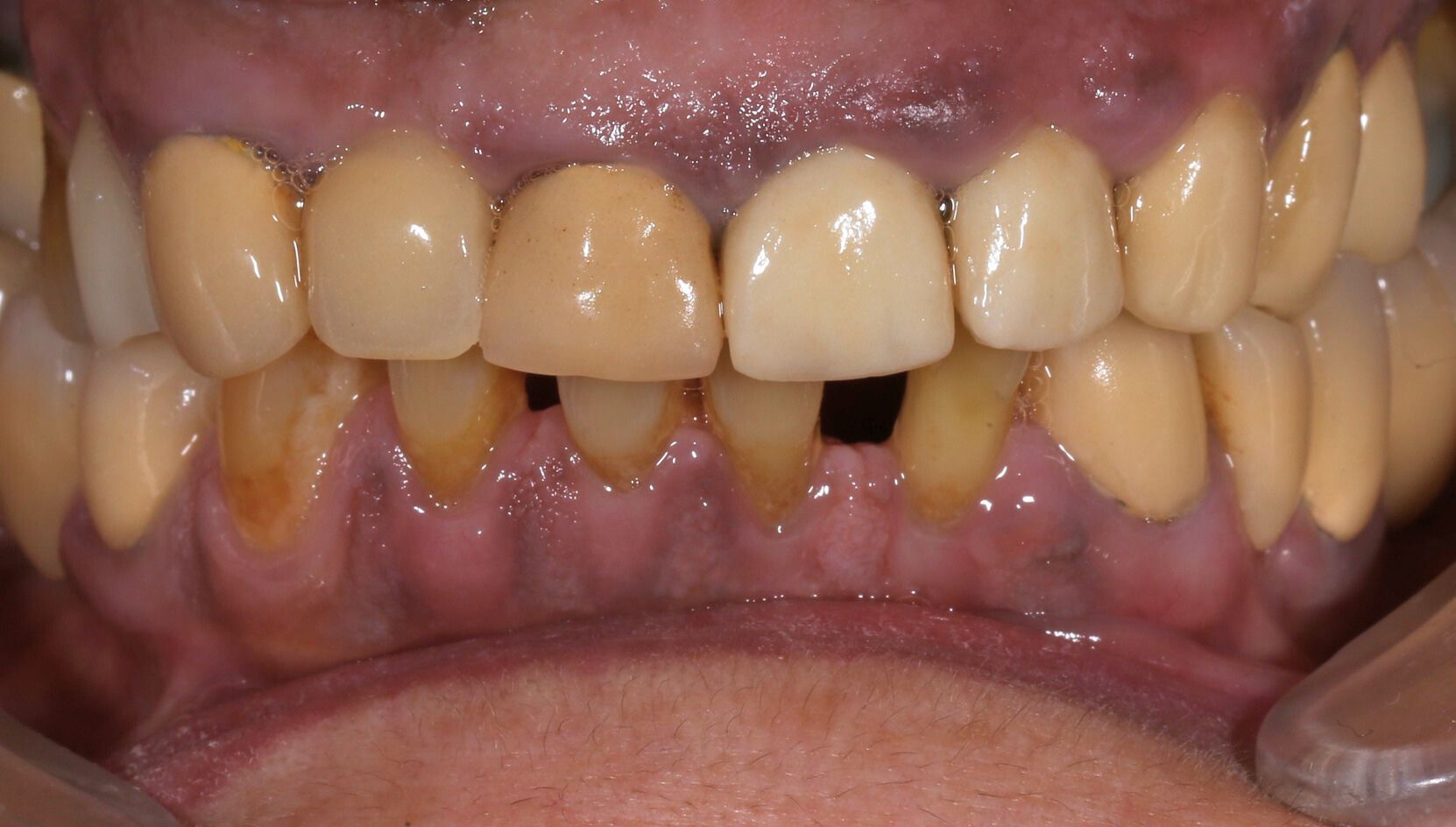 Dental case 4 X-ray before treatment