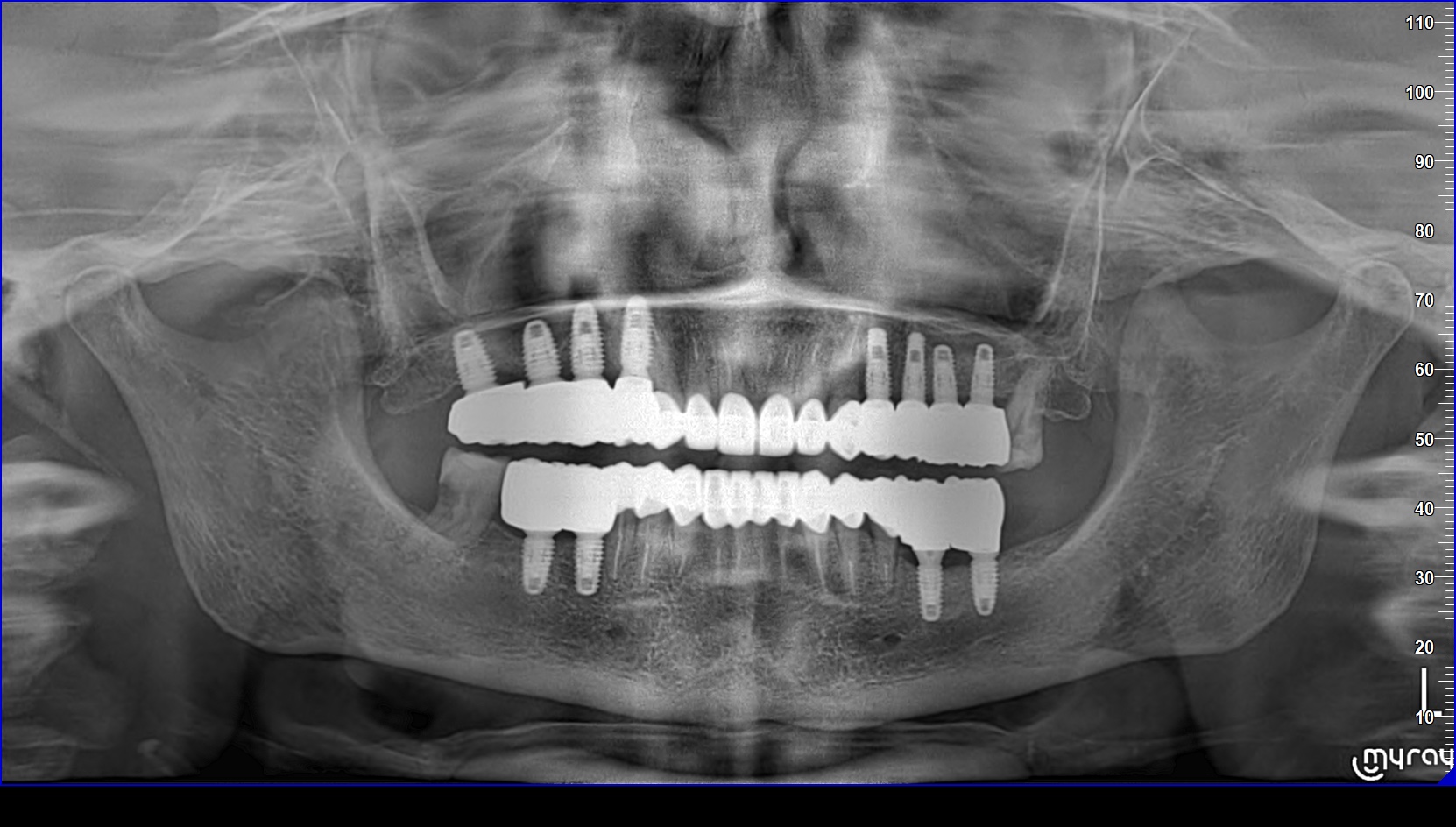 Dental case 5 after treatment