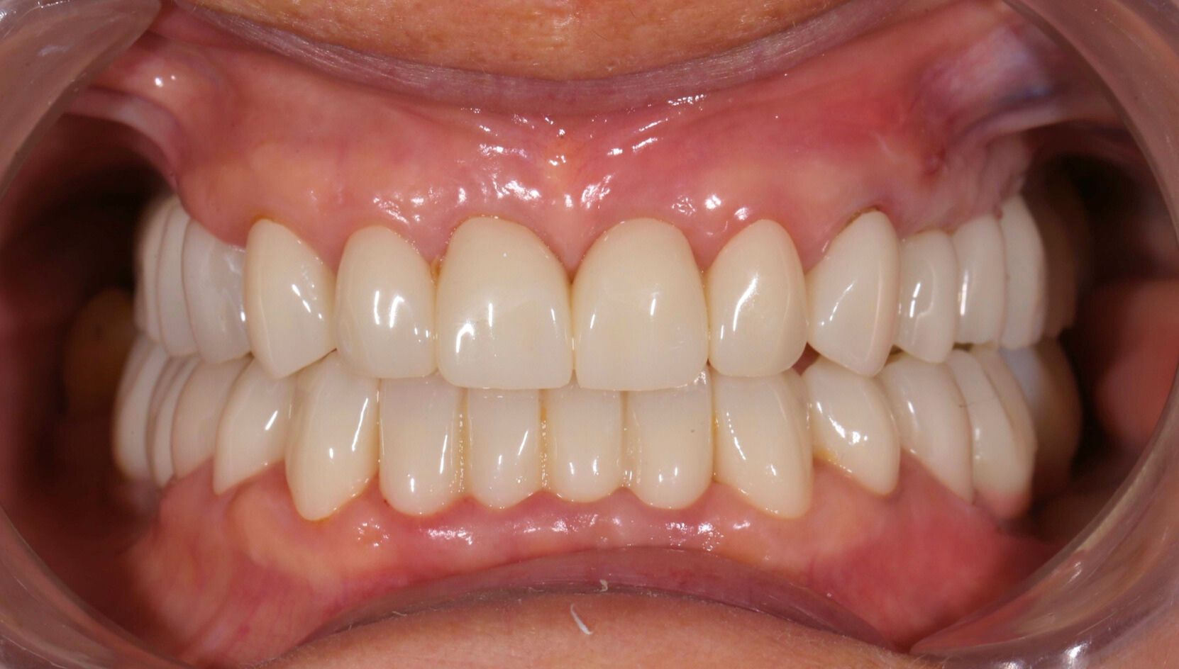 Dental case 5 X-ray after treatment