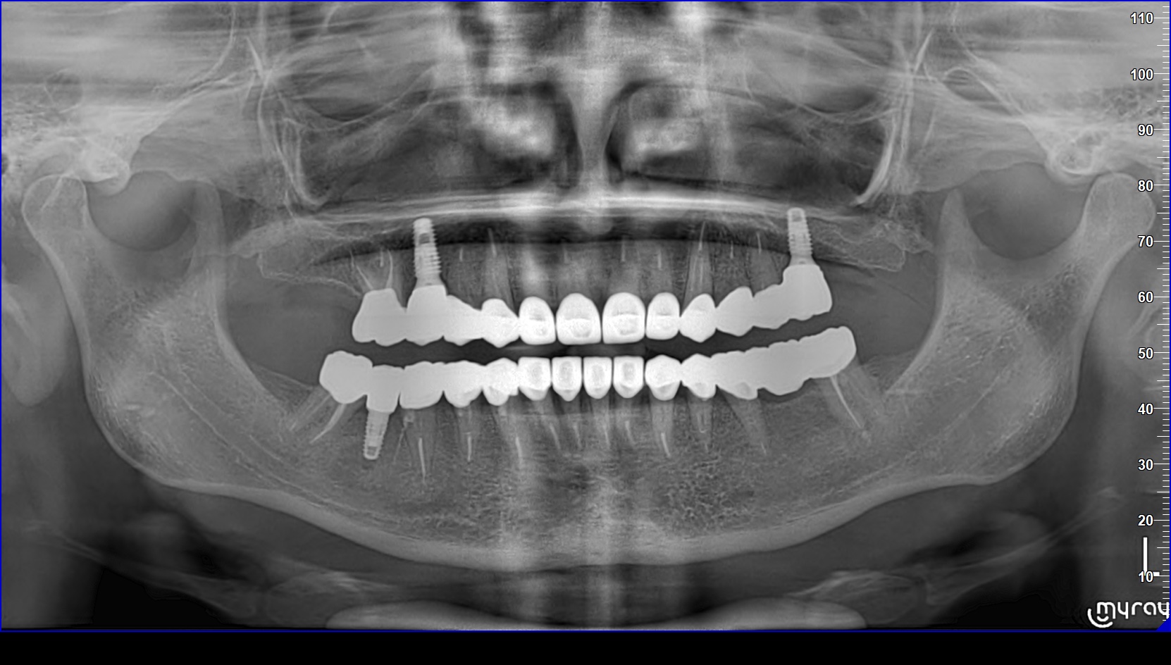 Dental case 6 after treatment