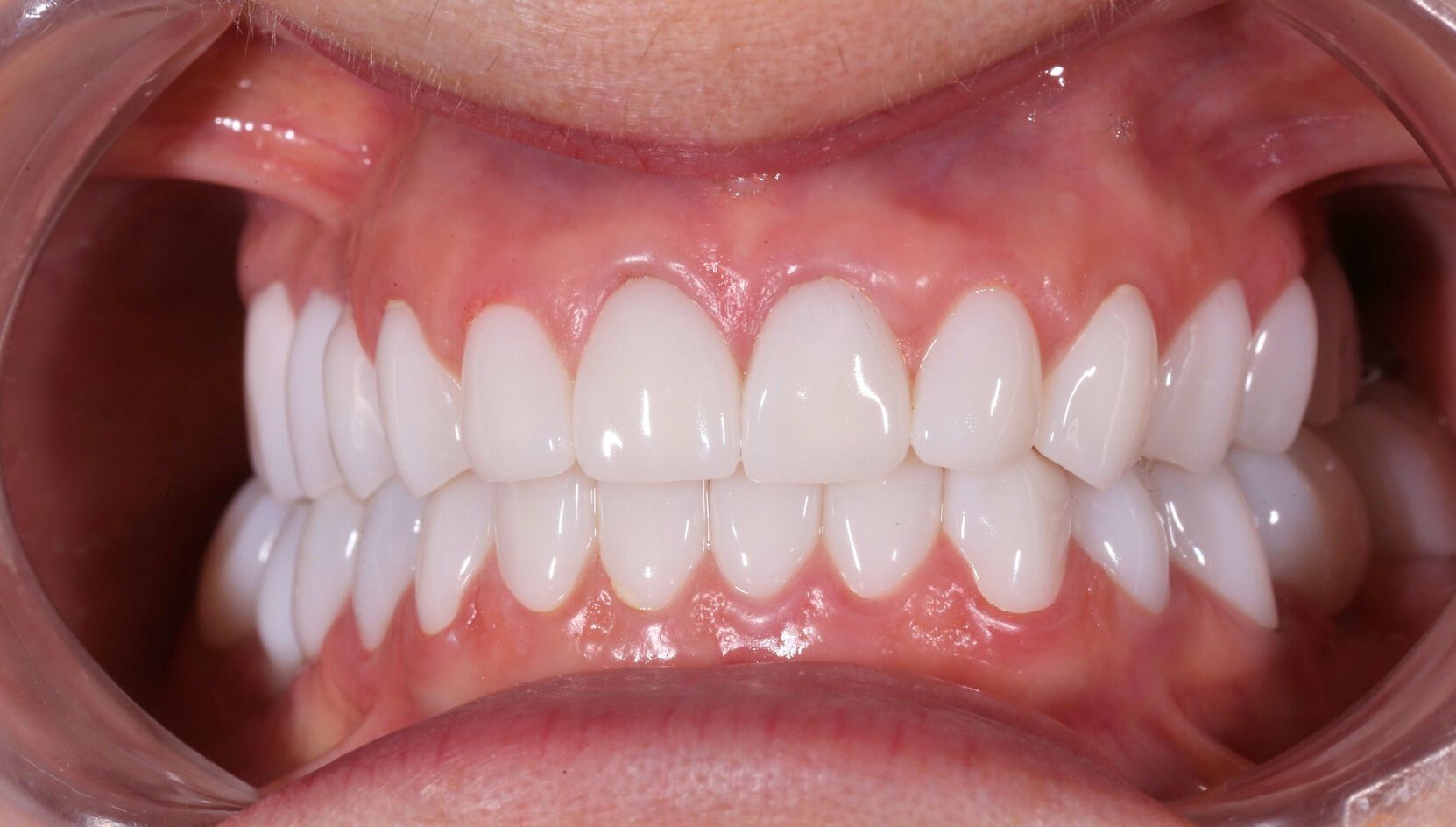 Dental case 6 X-ray after treatment