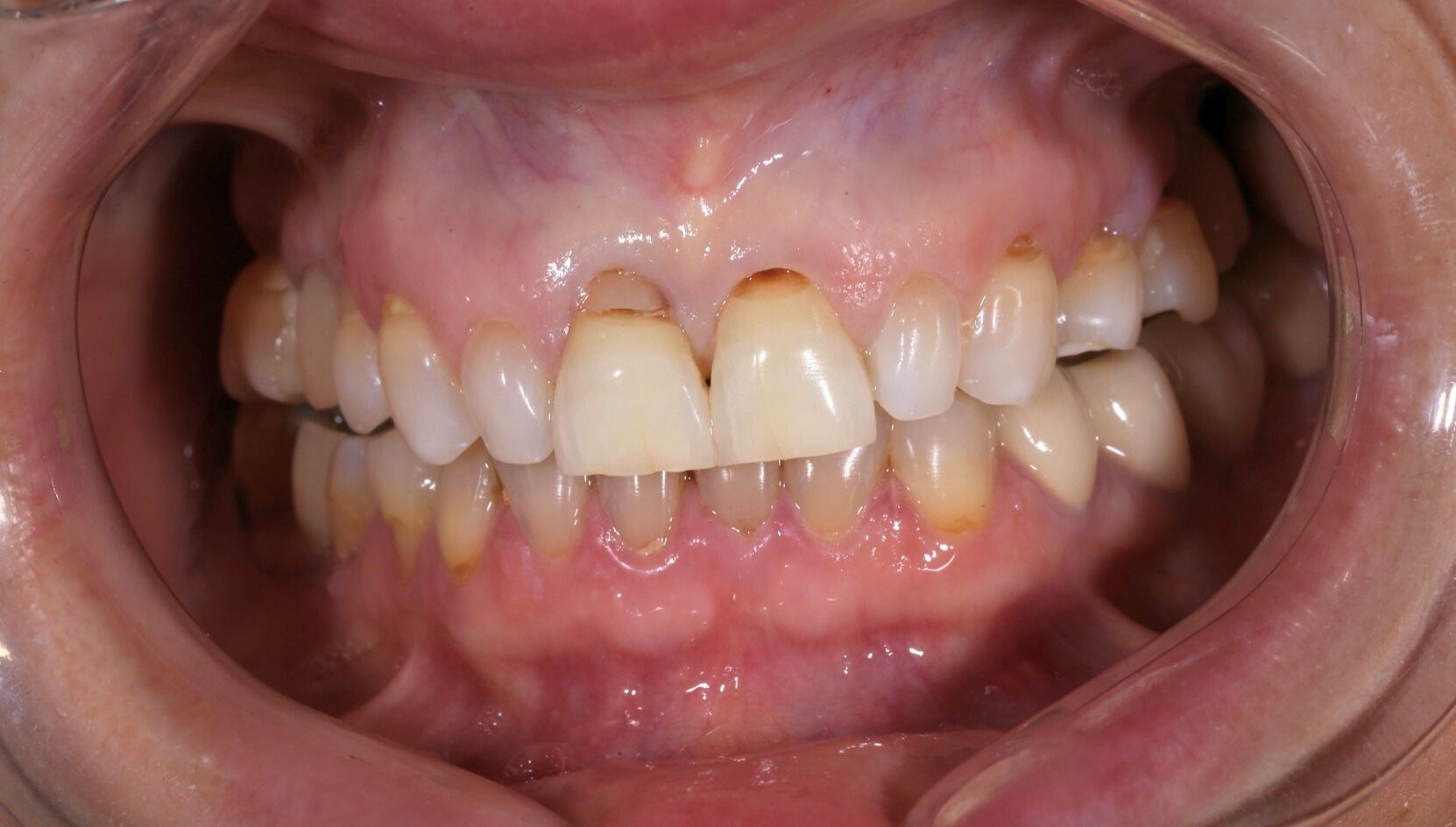 Dental case 6 X-ray before treatment