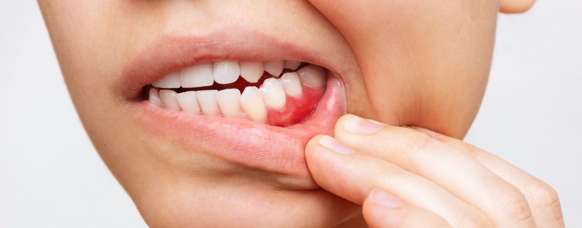 Gum & Bone Diseases